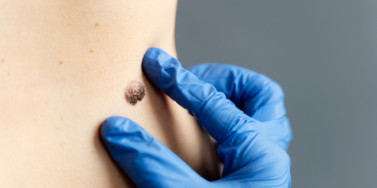 Skin Tags