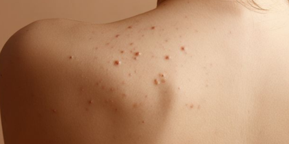 Warts